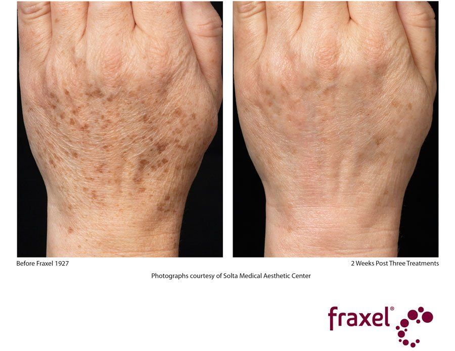 Fraxel laser before and after photos