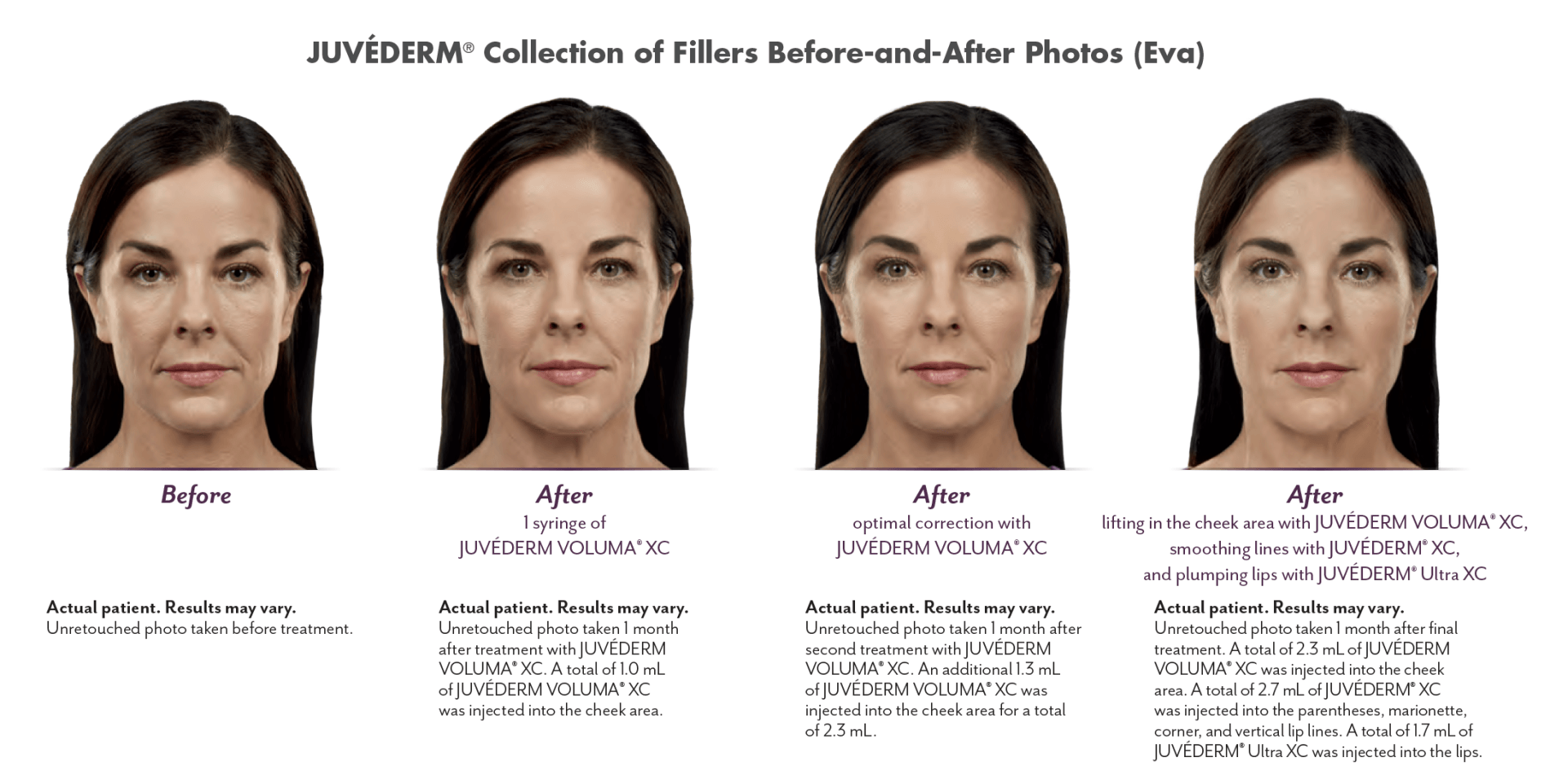 Juvéderm Collection of Fillers before and after photos