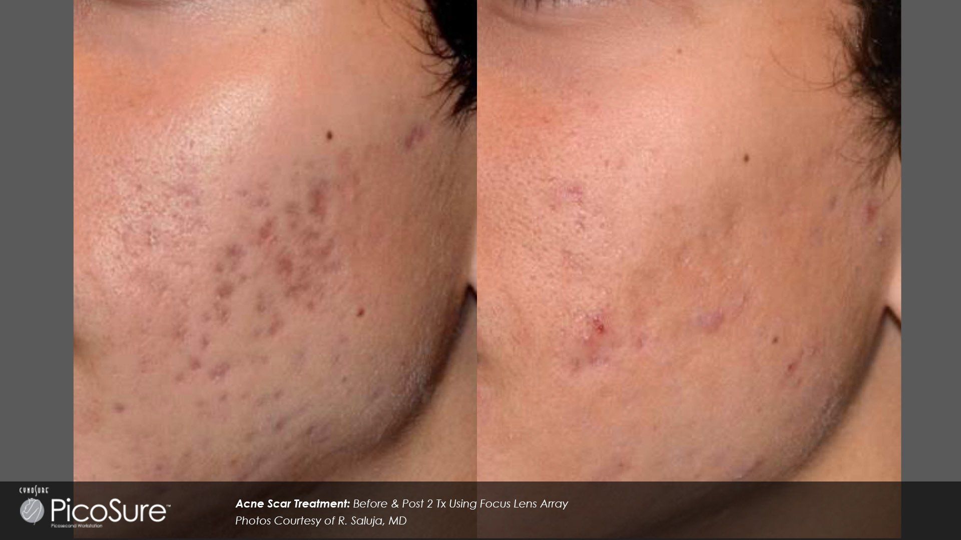 picosure laser treatment patient before and after