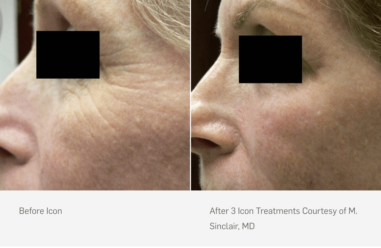 picosure laser treatment patient before and after