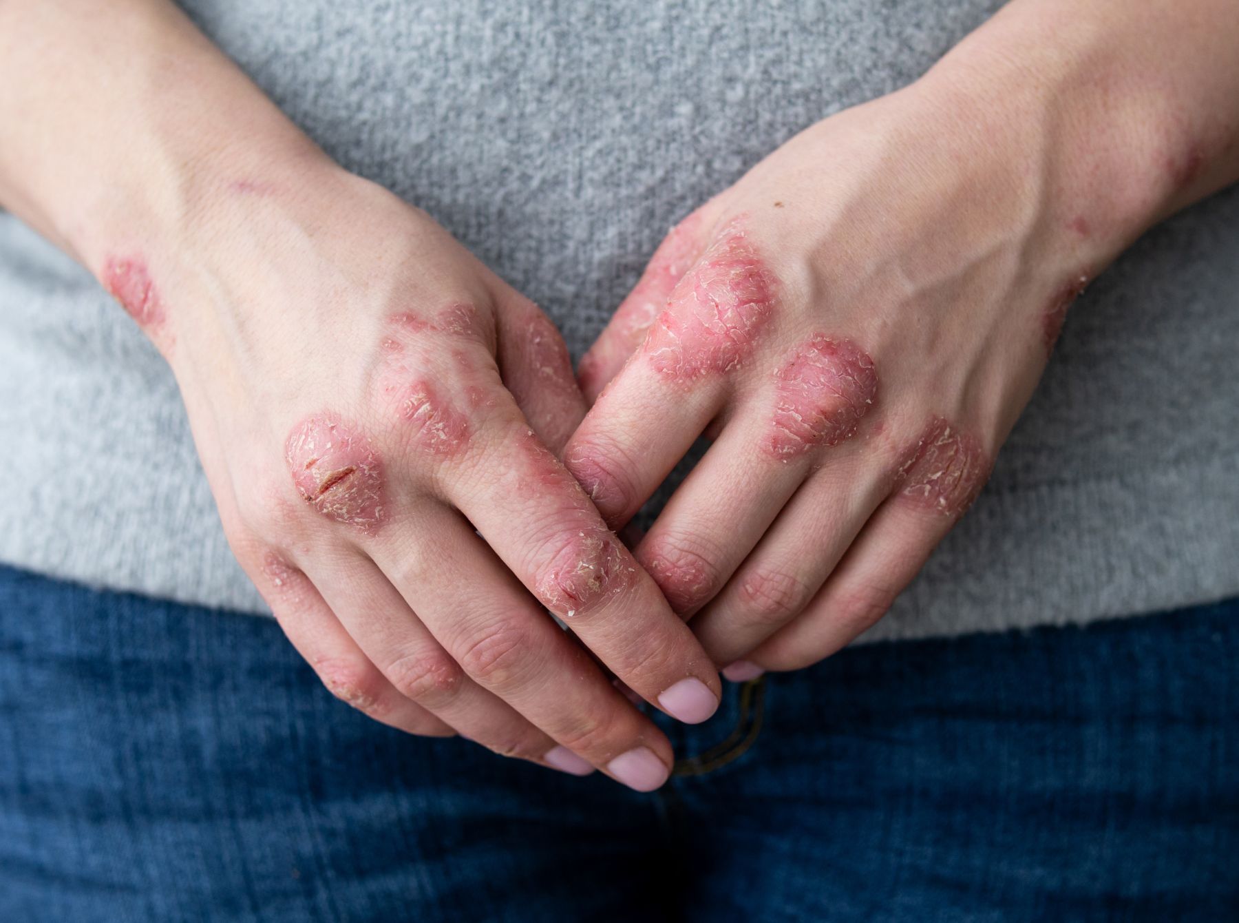 severe psoriasis on hands