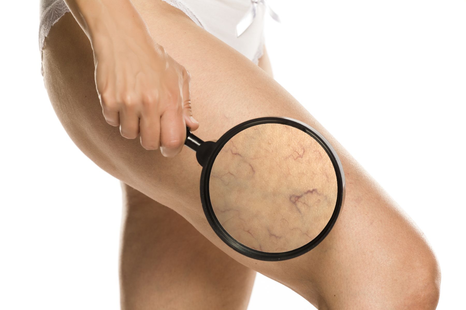 young woman fading brown spots with laser treatment