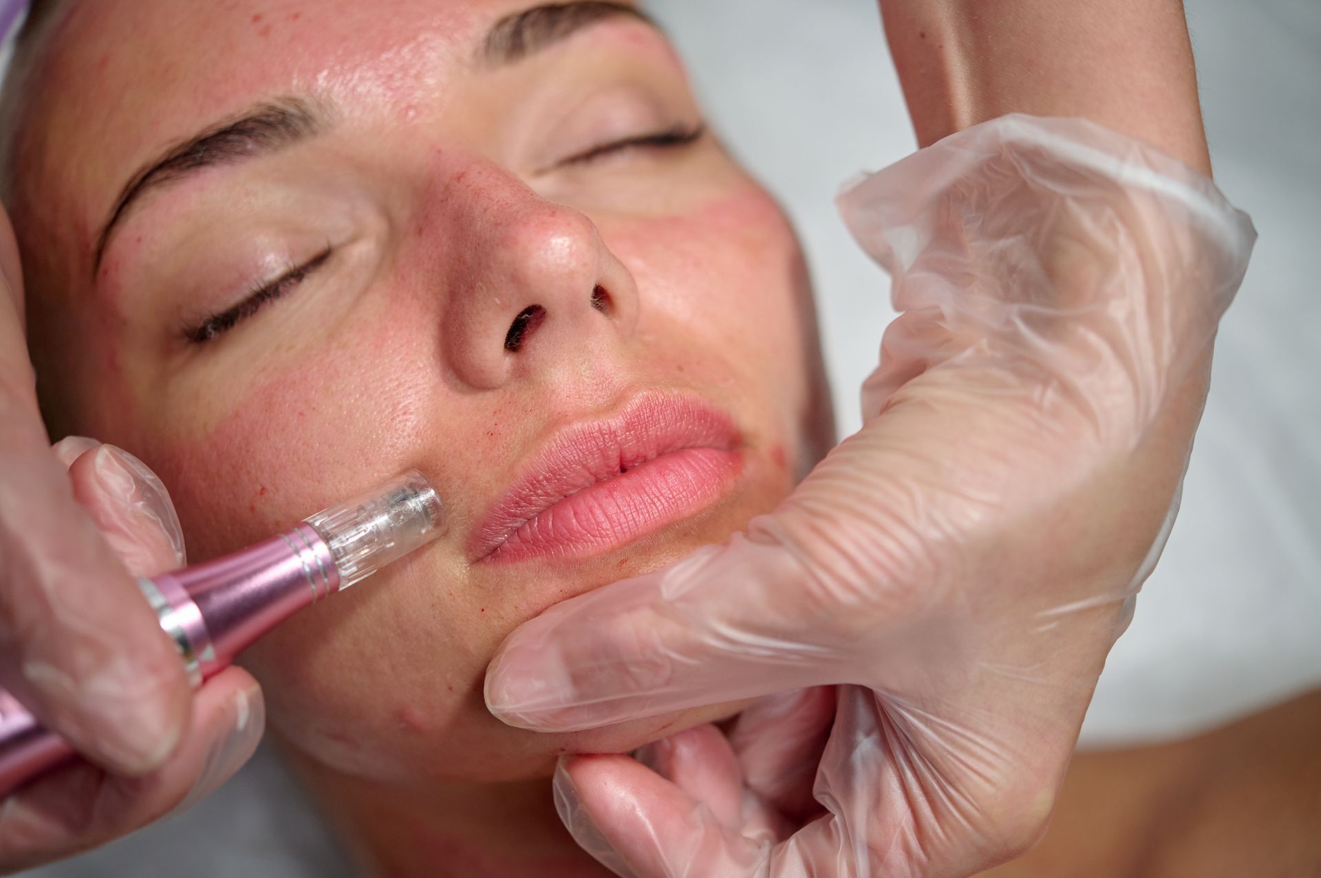 A woman faces receiving an SkinPen treatment