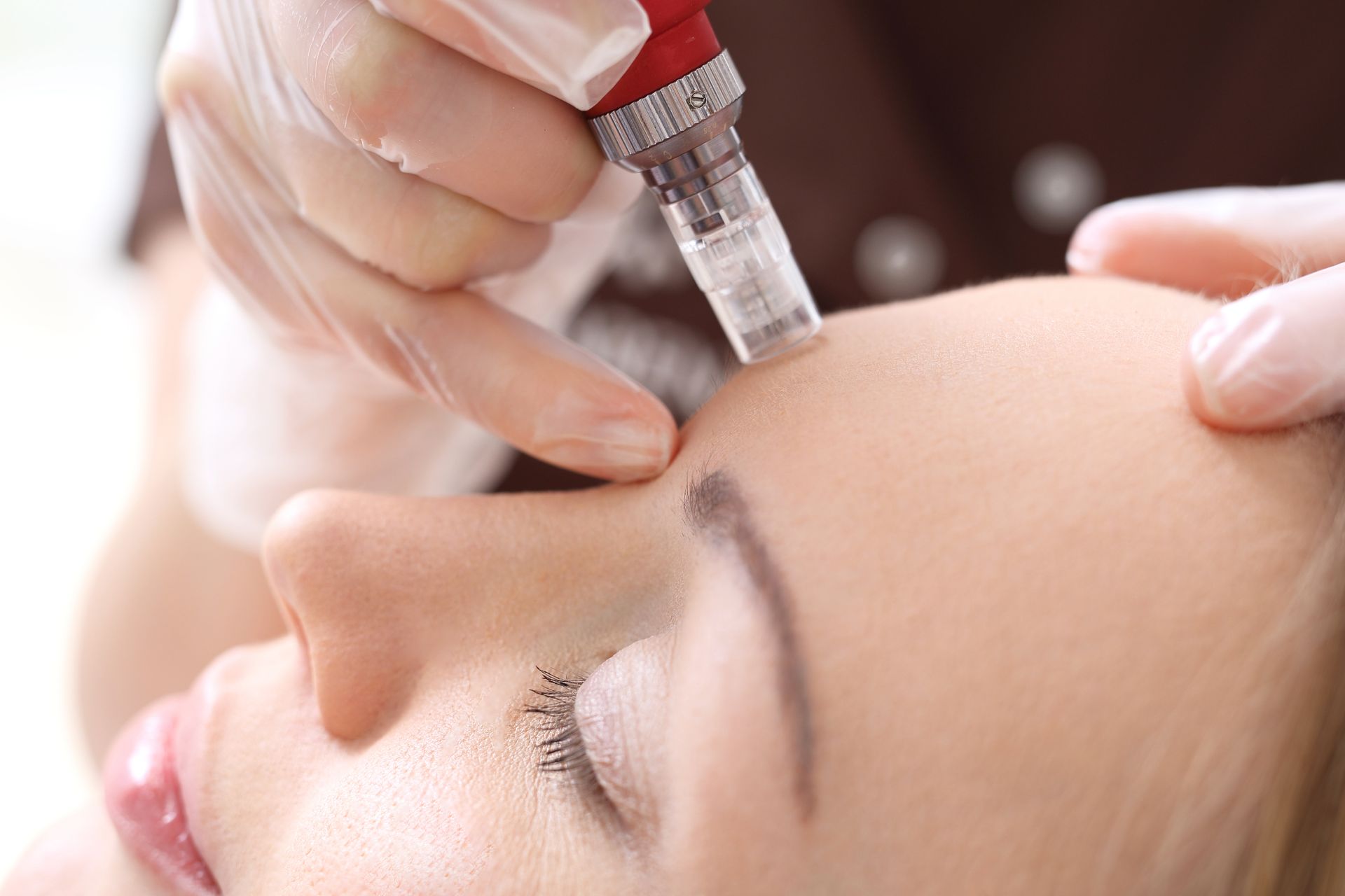 a woman is getting a microneedle treatment on her forehead .