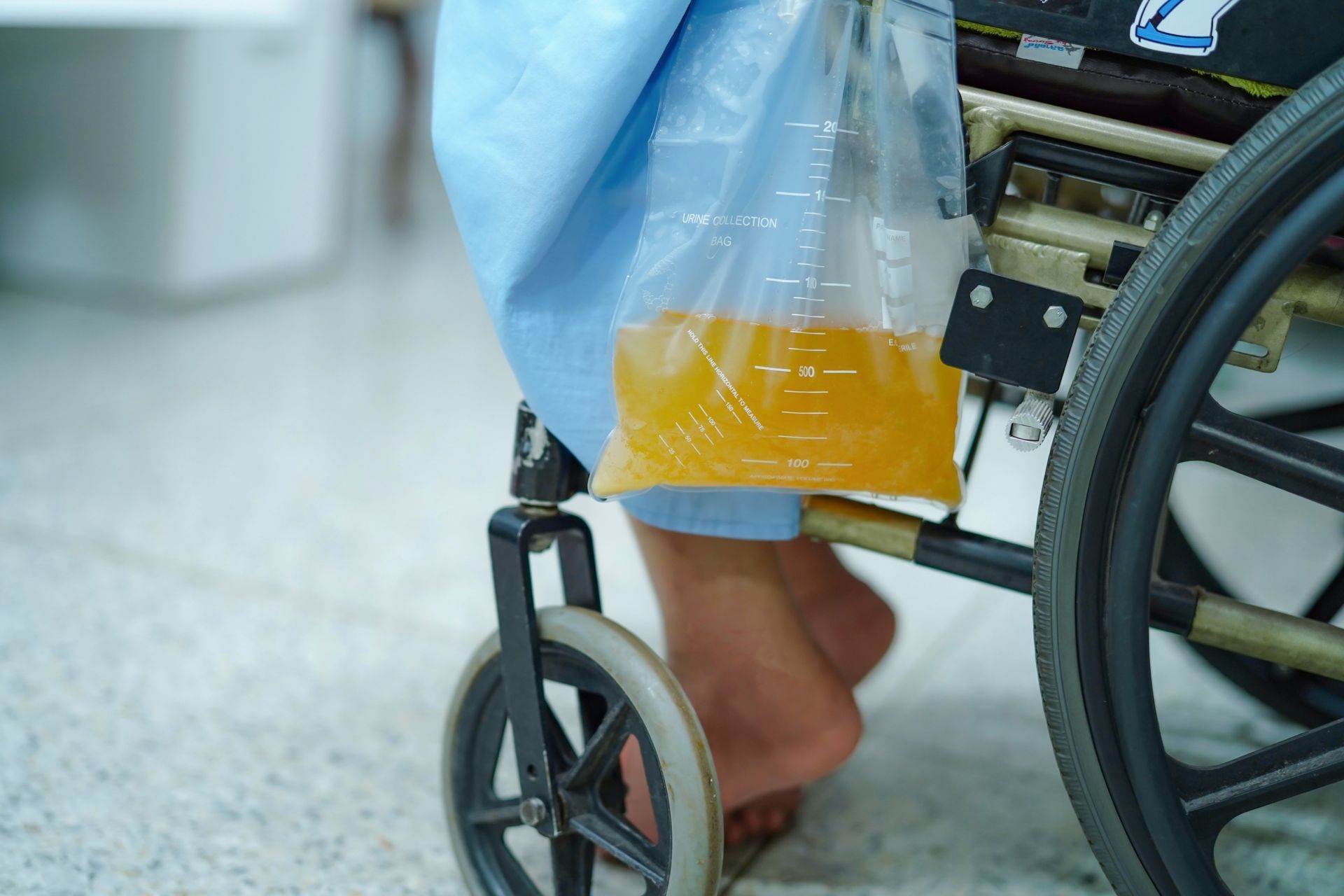 Urine bag attached to a wheelchair. The bag contains yellow liquid, and a person's foot is visible.