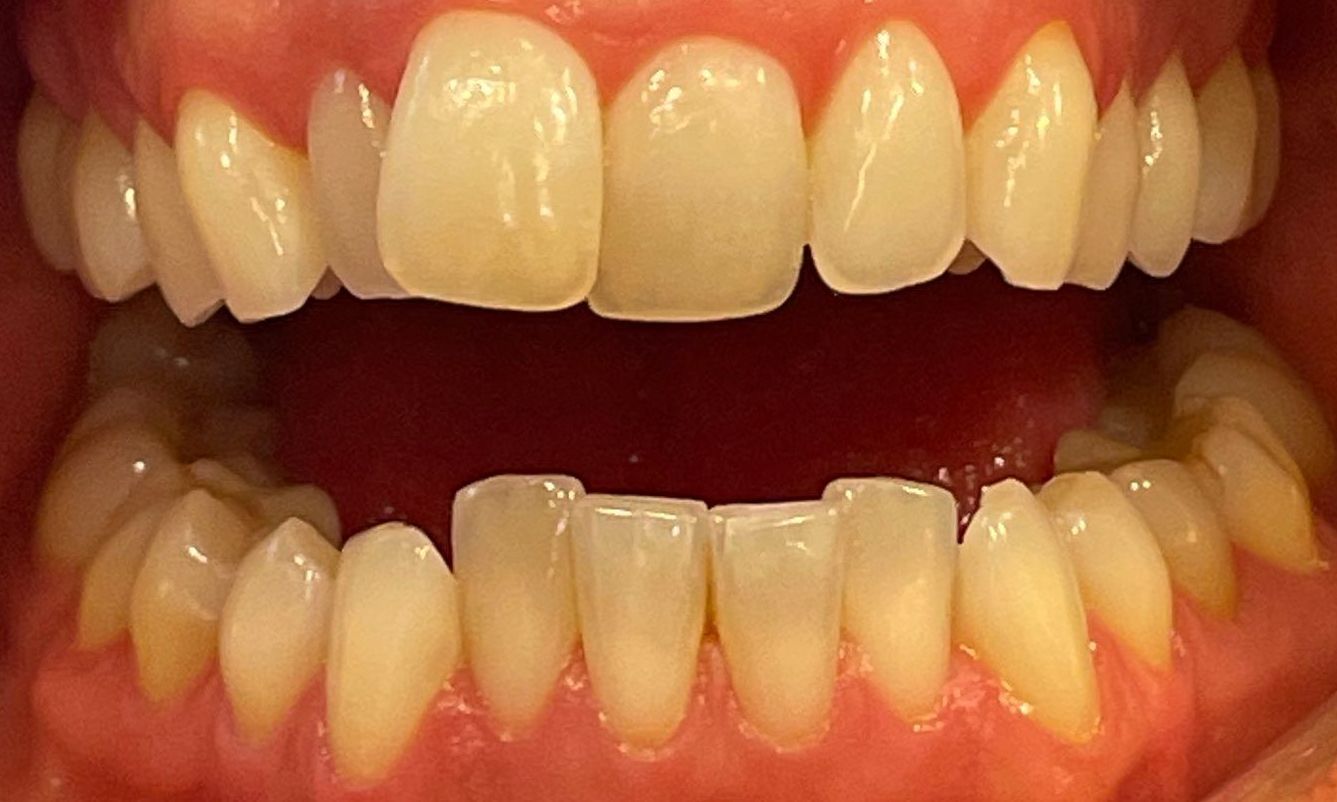 Usynlig tannregulering før 
