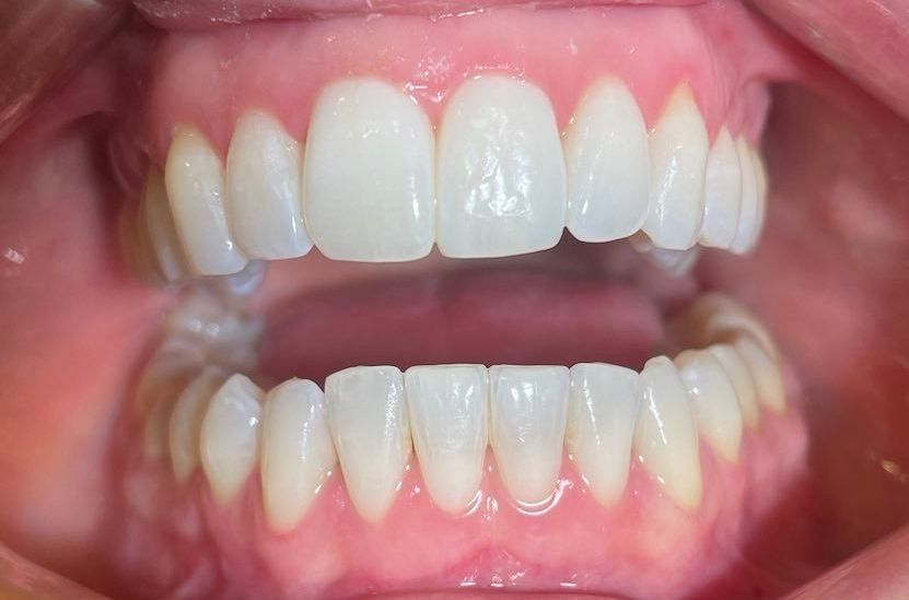 før og etter bilder av rette tenner med usynlig tannregulering
