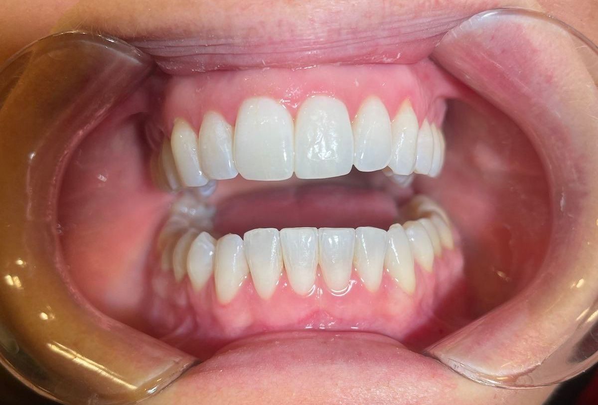 før og etter bilder av rette tenner med usynlig tannregulering