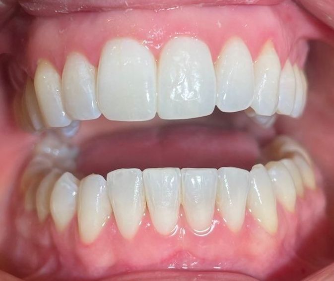 Usynlig tannreguleing fra Invisalign resultater. Tannlege Neddersan.