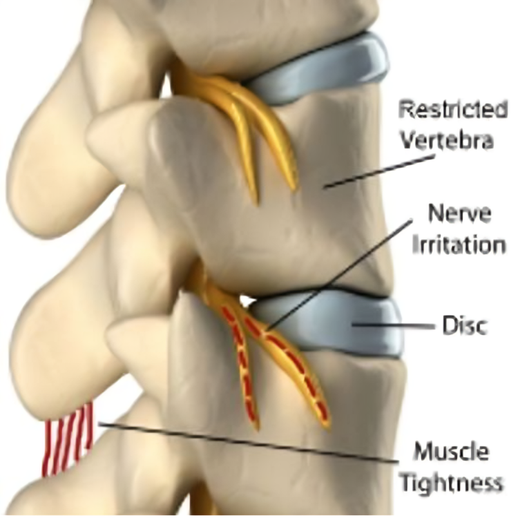 A diagram of a vertebra with muscle tightness and nerve irritation