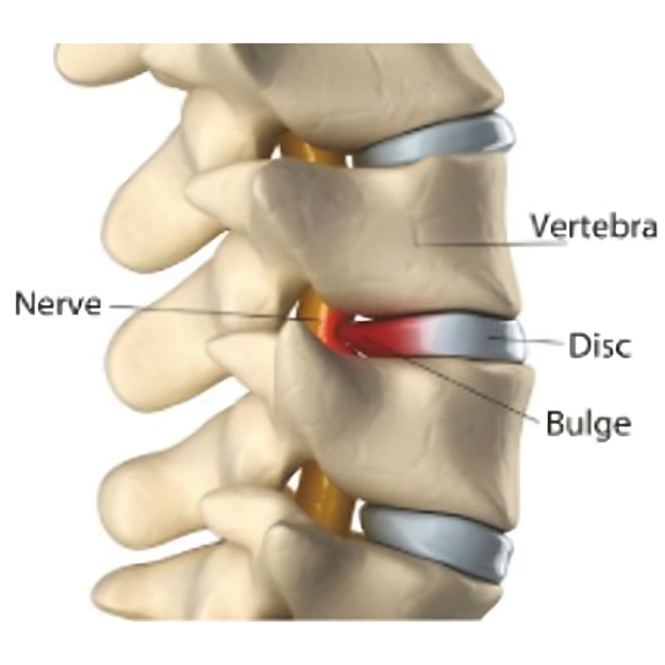 A diagram of the spine showing the nerves and disc bulge