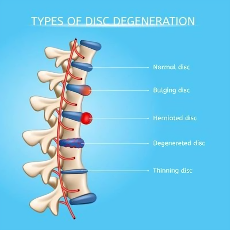 A diagram showing the different types of disc degeneration