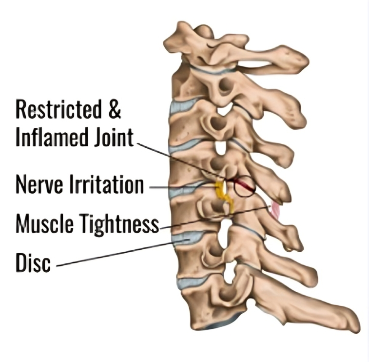 A diagram of a person 's neck showing a restricted and inflamed joint nerve irritation muscle tightness and disc