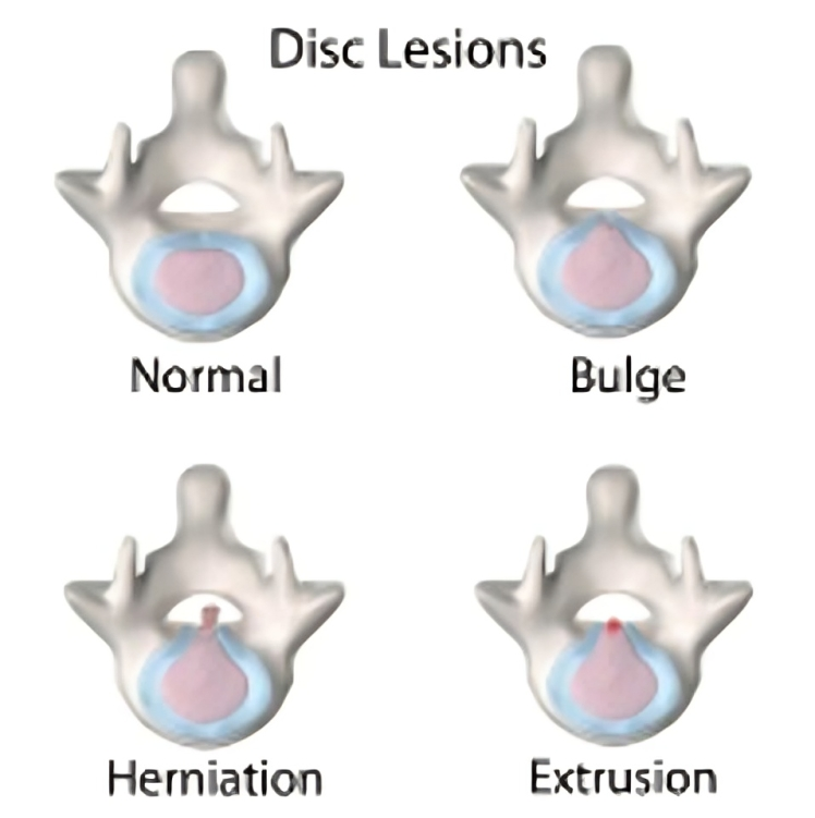 A diagram showing different types of disc lesions