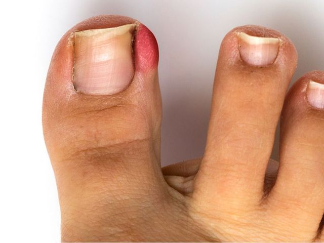 Ingrown Toenails - Foot and Ankle Wellness Centre