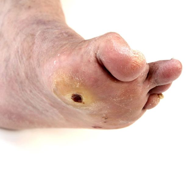 Foot Callus Treatment in Madurai, Tamil Nadu | Madurai Footcare Centre