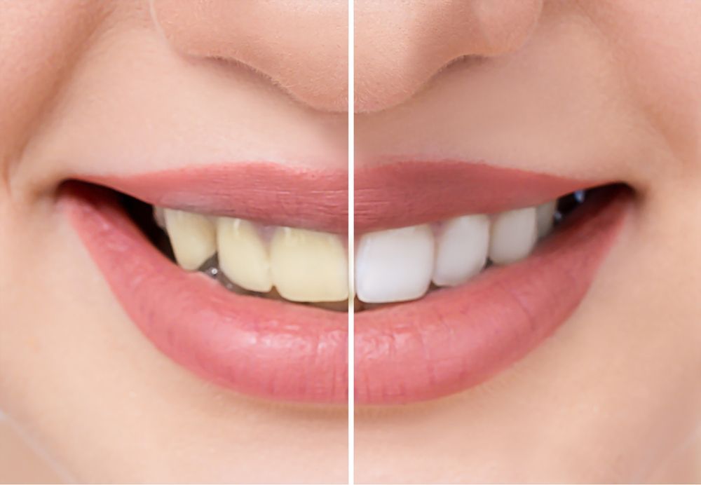 A before and after picture of a woman 's teeth.