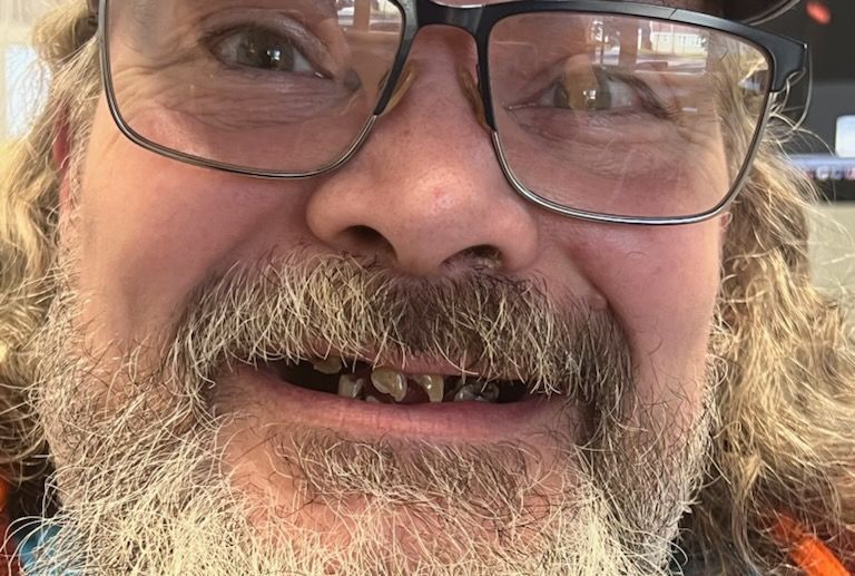 Mono Implant Case 6 - Before