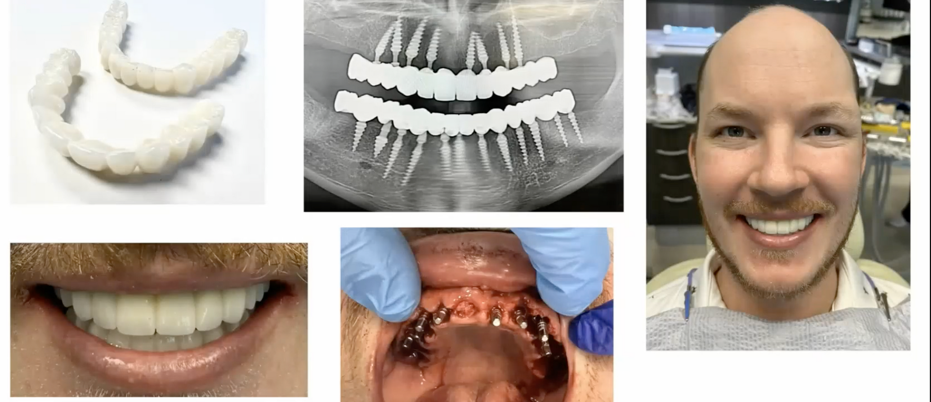 Mono Implant Case 1