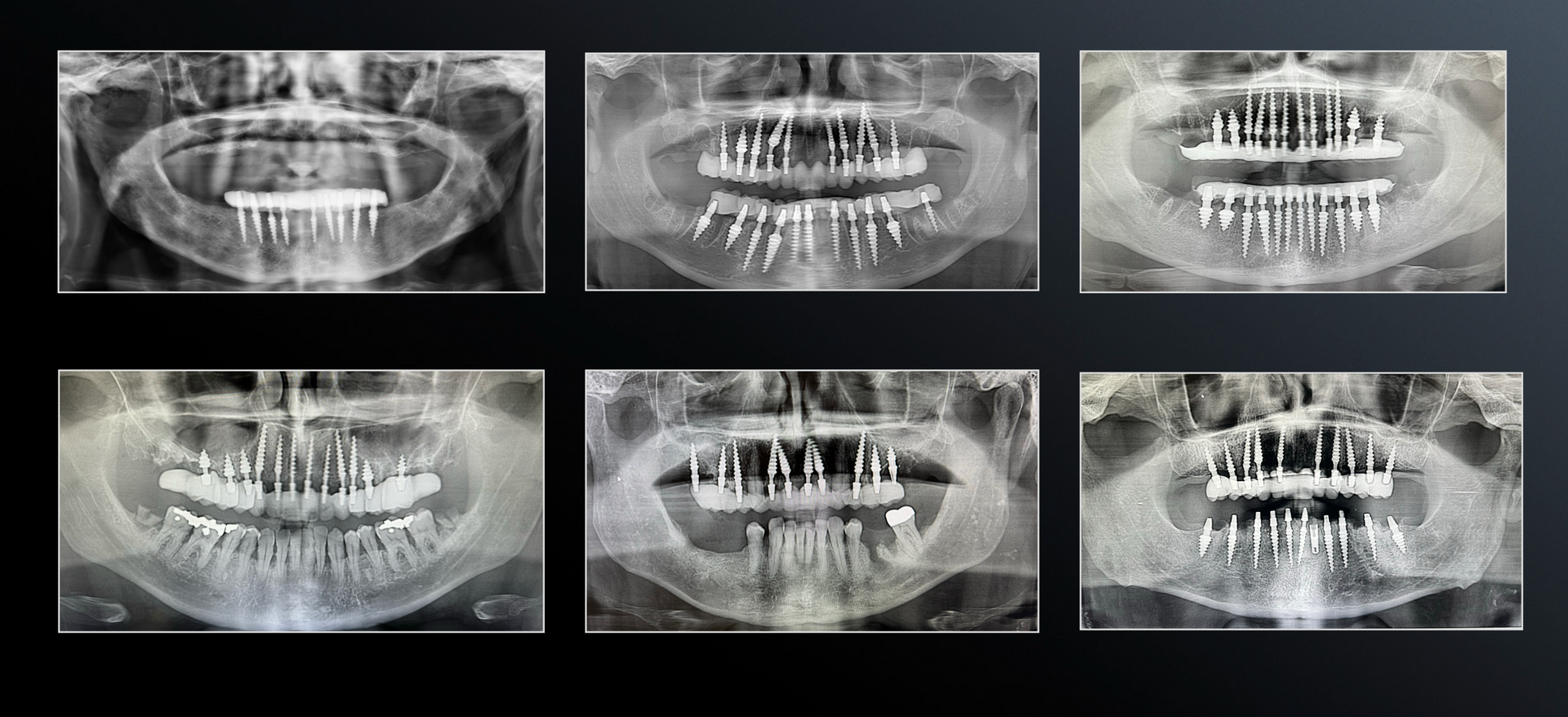 Mono Implant Scans