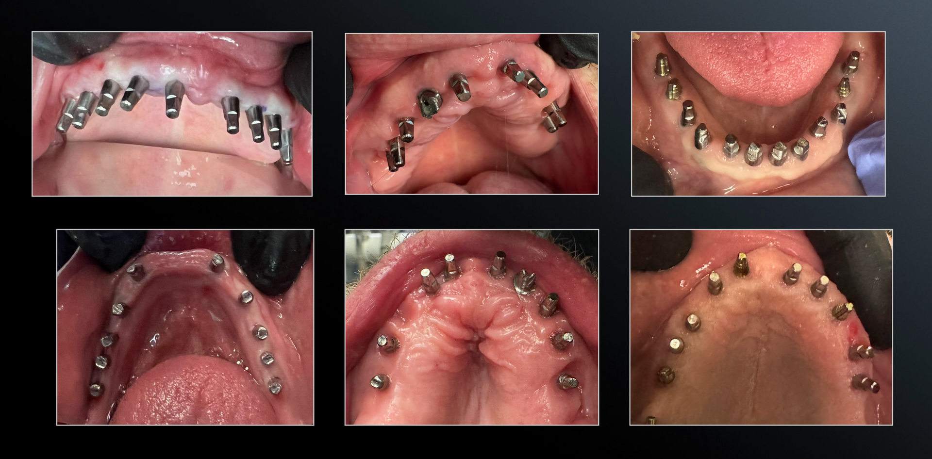 Mono Implant Placement and Healing