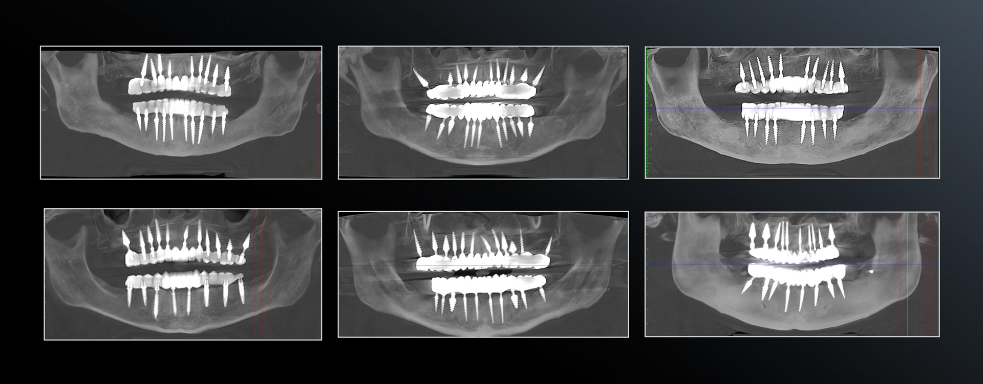 Mono Implant Scans