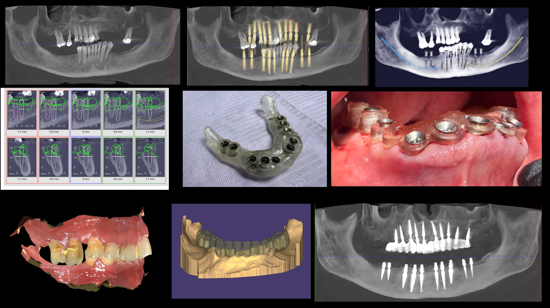 Mono Implant Case 1