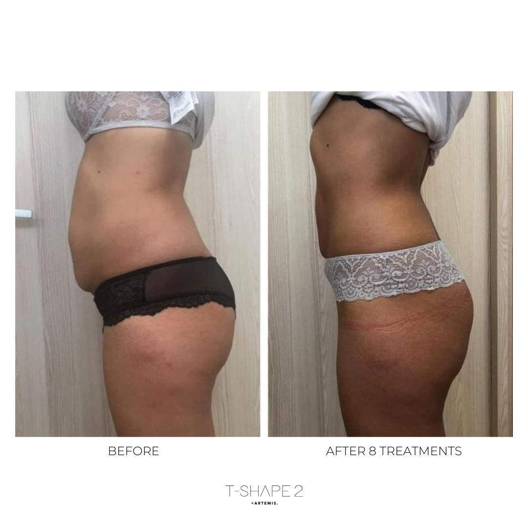 An Artemis T-Shape 2 before and after of a woman's belly and legs.