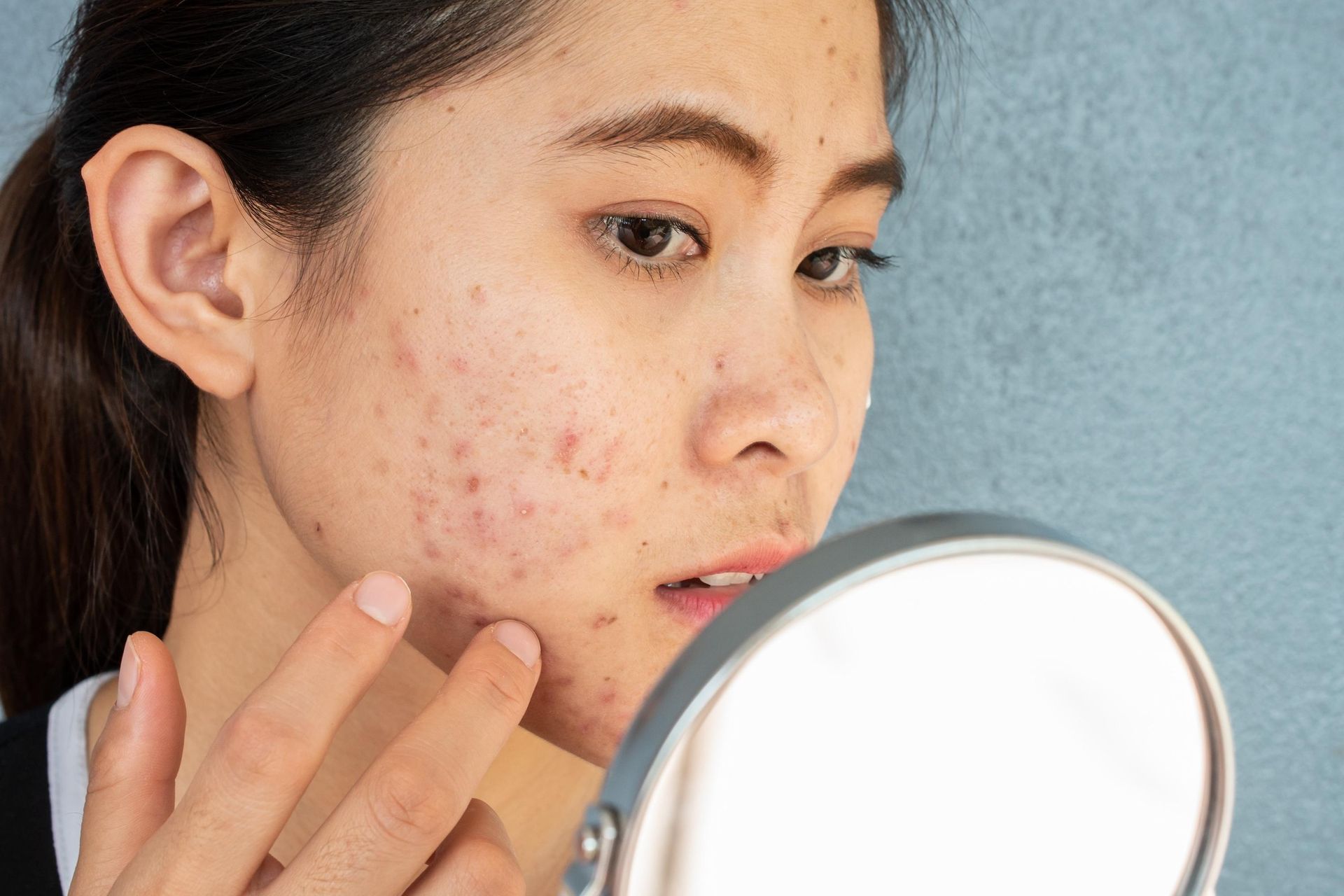 woman with acne