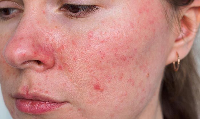 Client with visible rosacea redness on cheeks showing sensitive skin condition