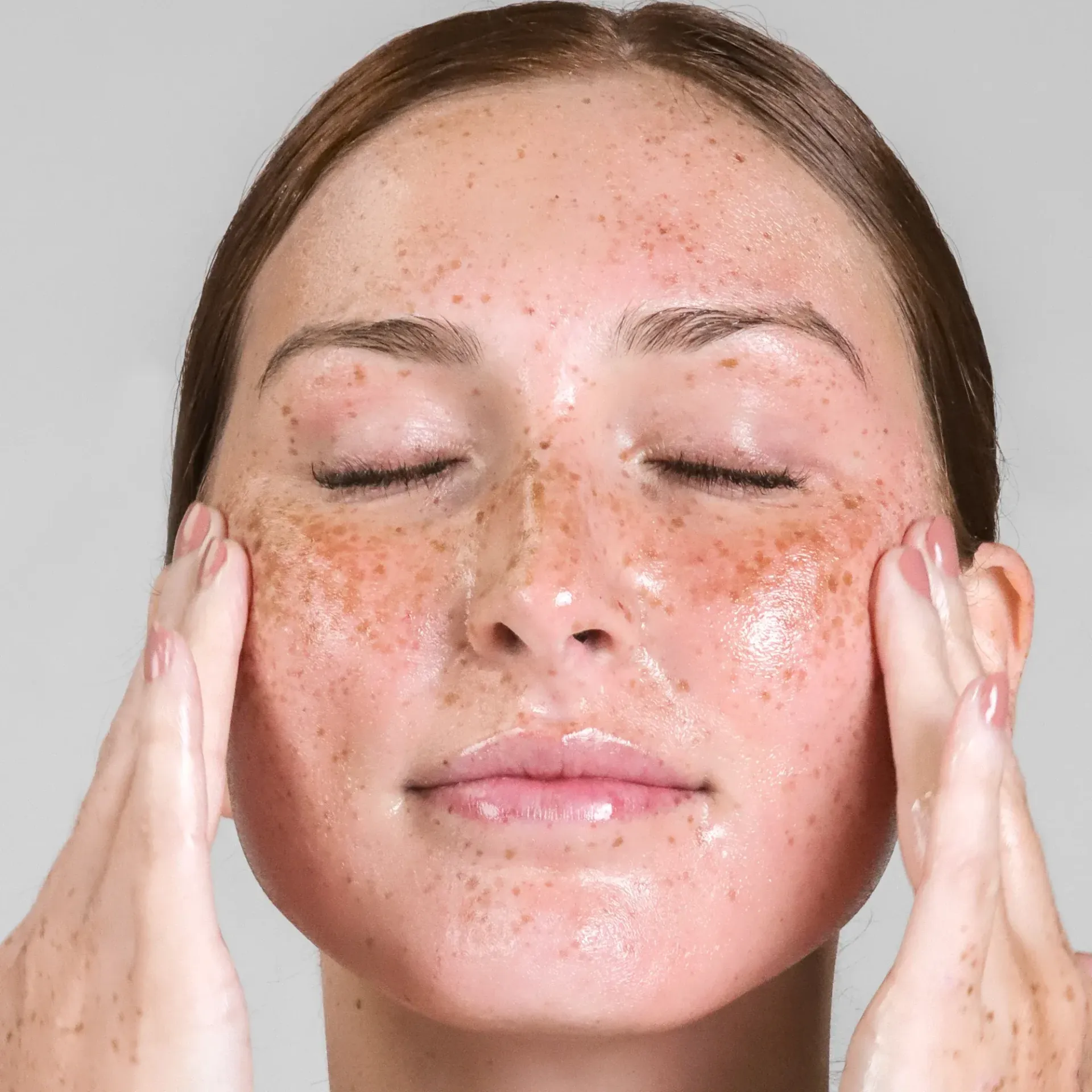 Close-up of sun-damaged skin showing freckles and pigmentation from UV exposure