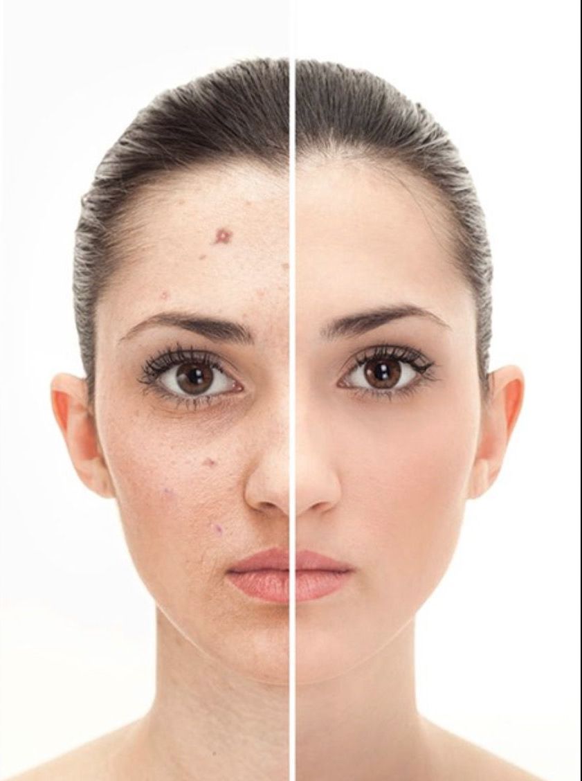 Pre and Post Lamprobe