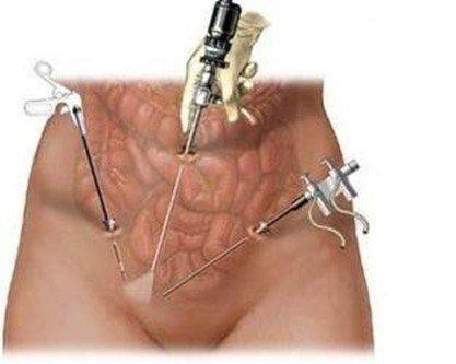 laparoscopia