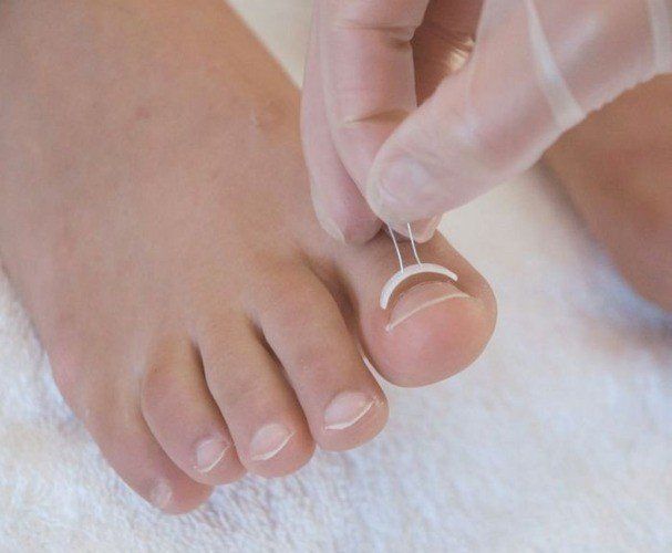 Een gehandschoende hand plaatst een draadbeugel op een teennagel; een voet.