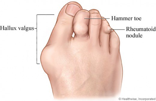 Voet met hallux valgus (knobbel), hamerteen en reumatoïde knobbel.