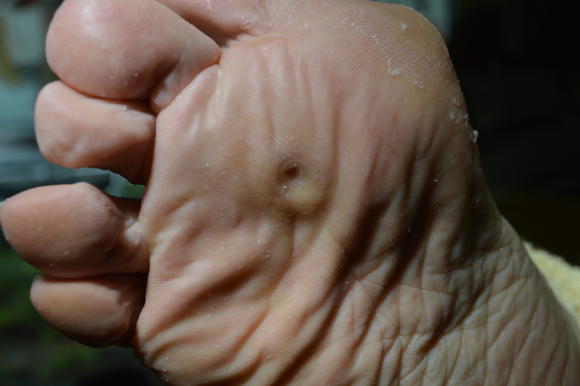 Close-up van een voetzool met een kleine, ronde wratachtige groei in het midden. De huid is bleek en gerimpeld.
