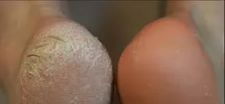 Hakjes van een voet, één gebarsten, één glad.