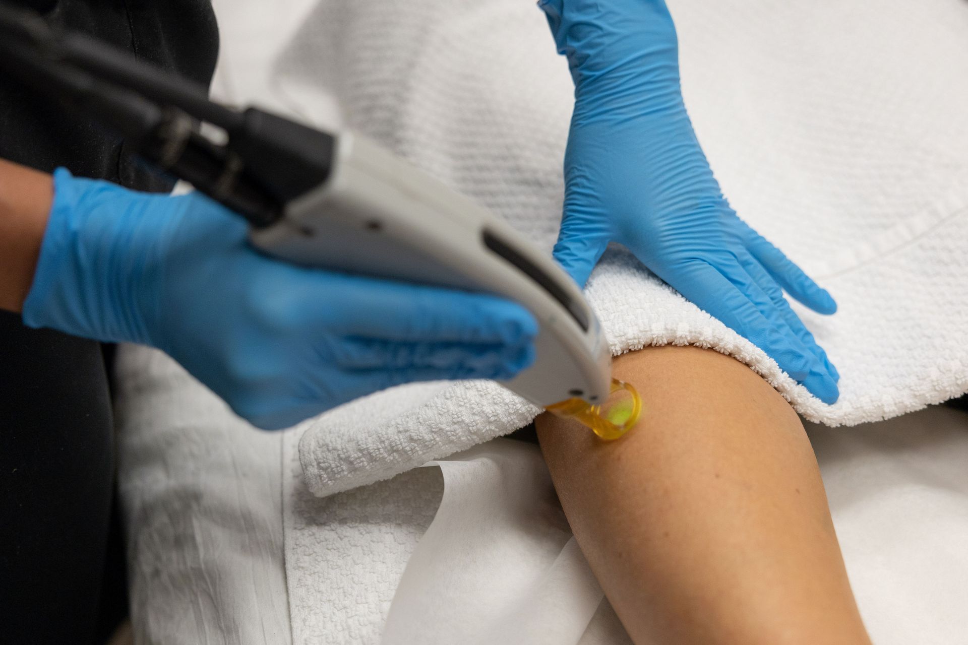 A woman is getting a laser hair removal treatment on her leg.