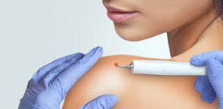 A woman is getting a wart removed from her shoulder.