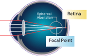 spherical aberration visual