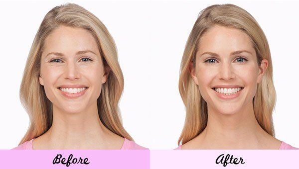 Woman Before and After Botox  — Big Rapids, MI — Crew & Boss Eye Associates