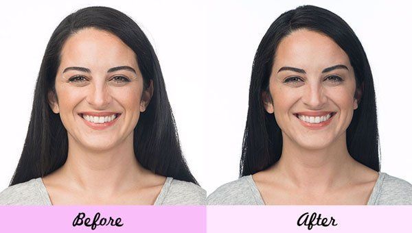 Lady Before and After Botox  — Big Rapids, MI — Crew & Boss Eye Associates