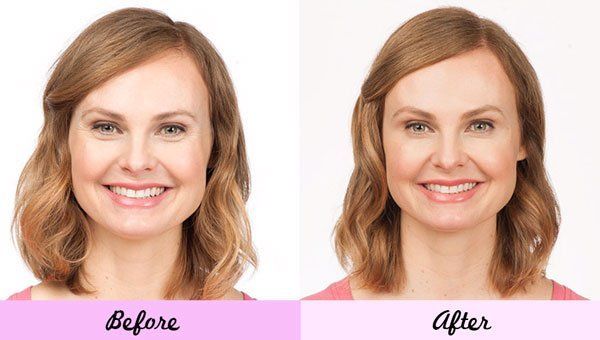 Pretty Lady Before and After Botox  — Big Rapids, MI — Crew & Boss Eye Associates