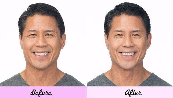 Man Before and After Botox  — Big Rapids, MI — Crew & Boss Eye Associates