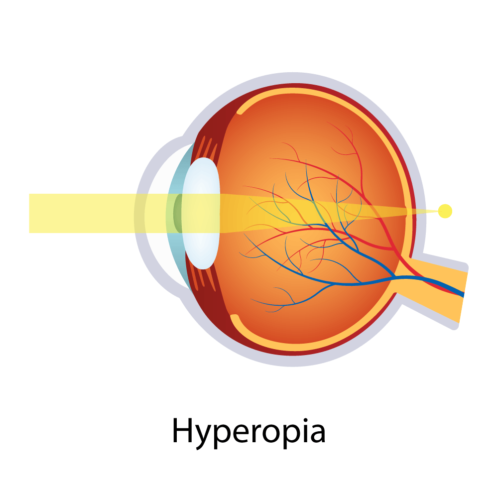 Hyperopia — Big Rapids, MI — Crew & Boss Eye Associates