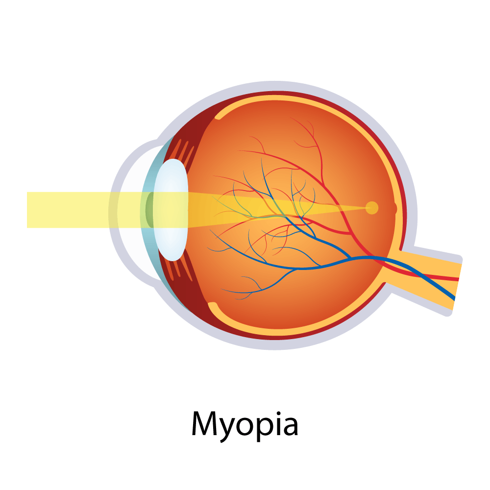 Myopia — Big Rapids, MI — Crew & Boss Eye Associates