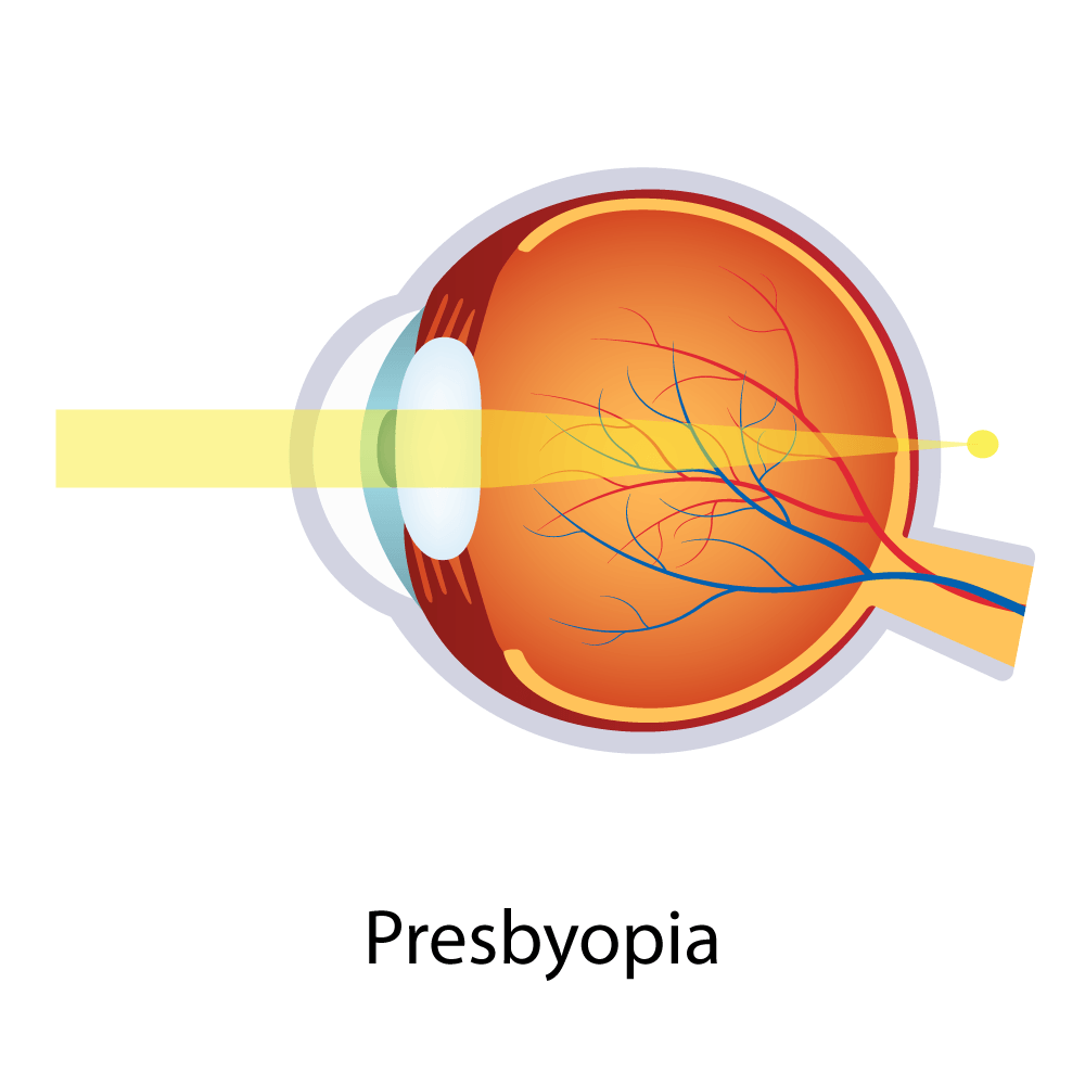 Presbyopia — Big Rapids, MI — Crew & Boss Eye Associates