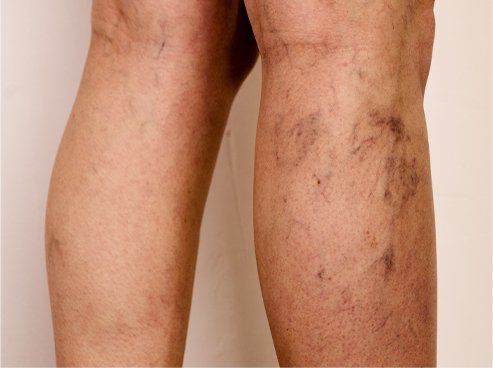 spider veins