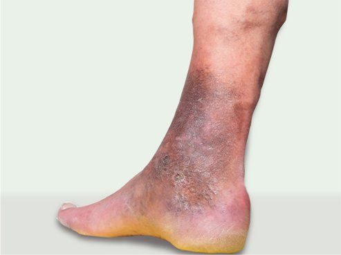 venous ulcer on ankle
