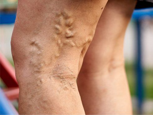 varicose veins